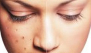 Cara menghilangkan flek hitam pada wajah secara alami