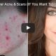 How To Cover Acne & Scars (IF You Want To