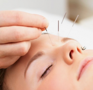 Akupuntur Salah Satu Metode Perawatan Wajah Terbaik