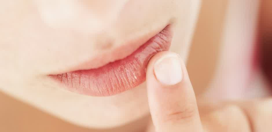 perawatan pada bibir kering