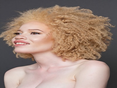 bagaimana kecantikan penderita albino bisa memikat 