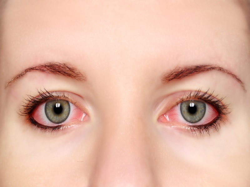 penyebab mata gatal yang sering diremehkan