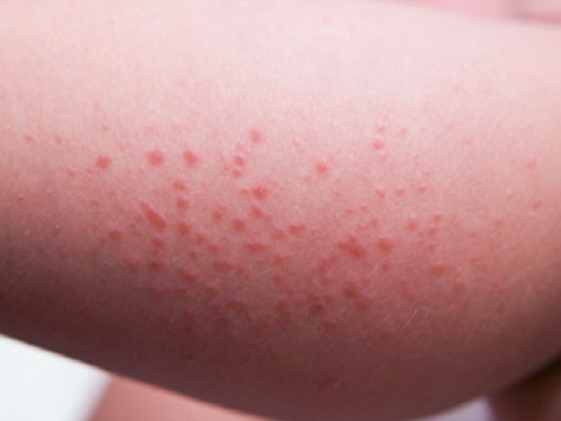 fakta kesehatan tentang alergi kerang