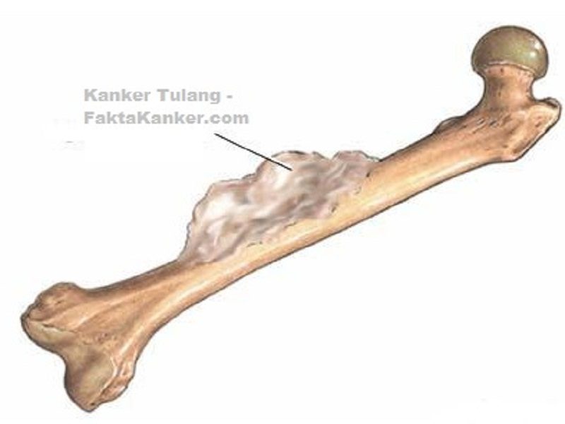 Yang Harus Dipahami Tentang Gejala dari Kanker Tulang ...