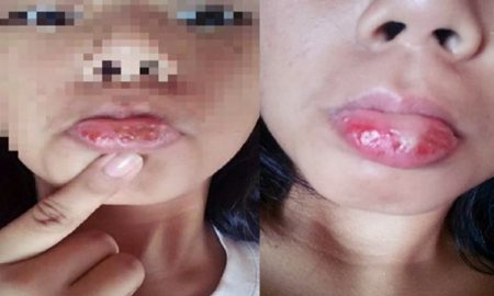 Efek buruk lipstik bermerkuri